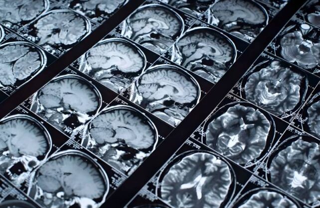 کشف پروتئین DMTF1 برای بازسازی سلول های عصبی و معکوس سازی پیری مغز