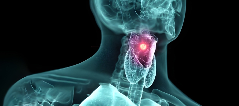 گرفتگی صدا را جدی بگیرید: نشانه هشدار دهنده سرطان حنجره